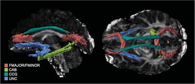 Acute White Matter Integrity Post-trauma and Prospective Posttraumatic Stress Disorder Symptoms